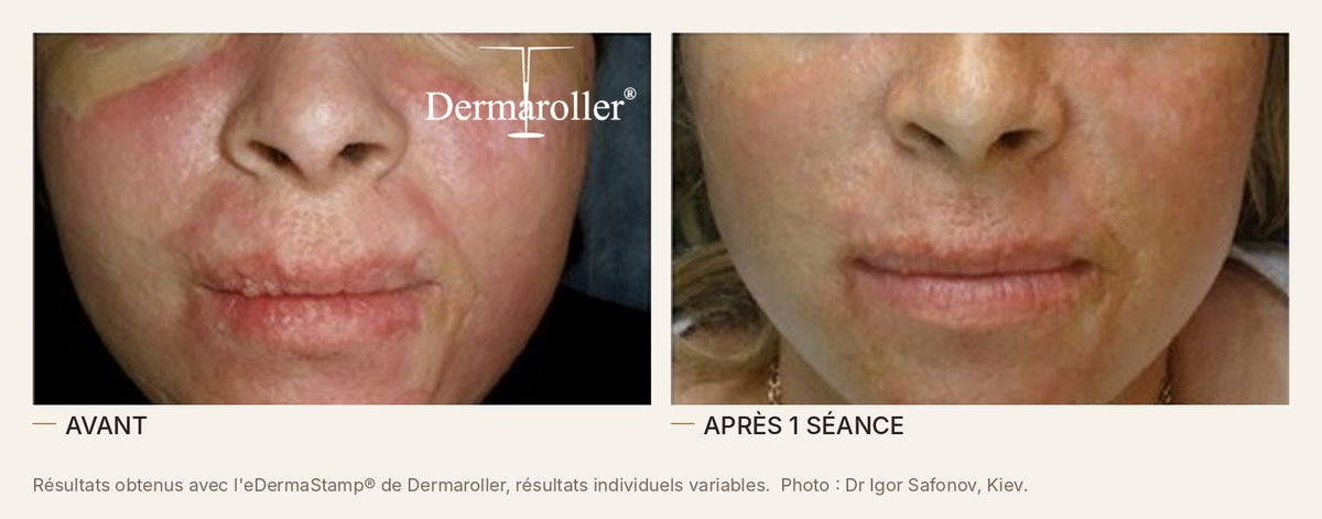 Avant et après un microneedling à l'eDermaStamp de Dermaroller, cicatrices autour de la bouche