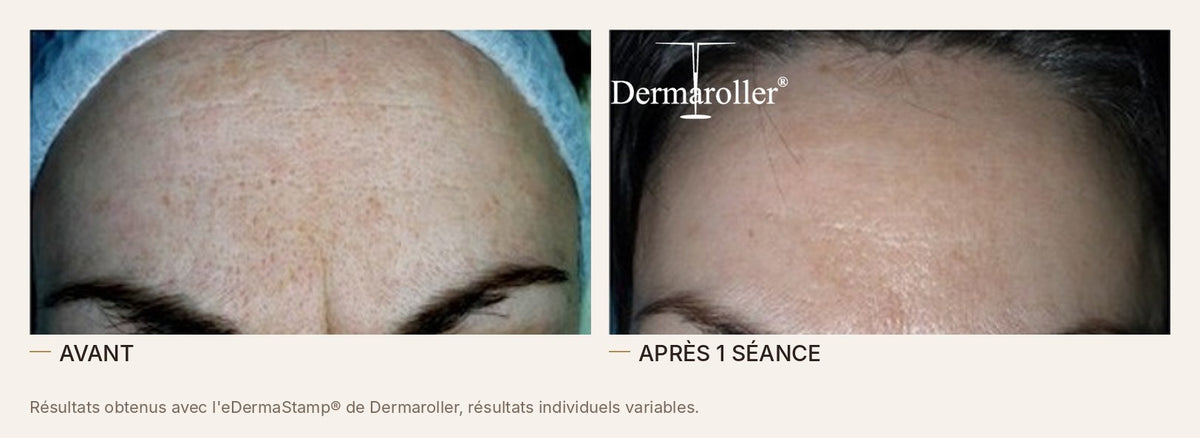 Avant et après un microneedling à l'eDermaStamp de Dermaroller, front