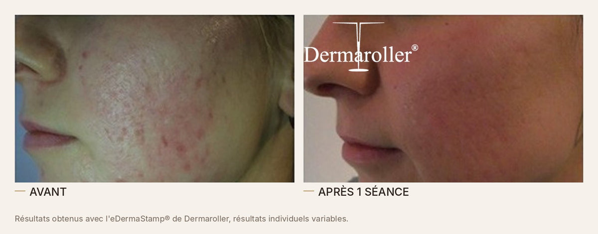 Avant et après un microneedling à l'eDermaStamp de Dermaroller, acné de la joue