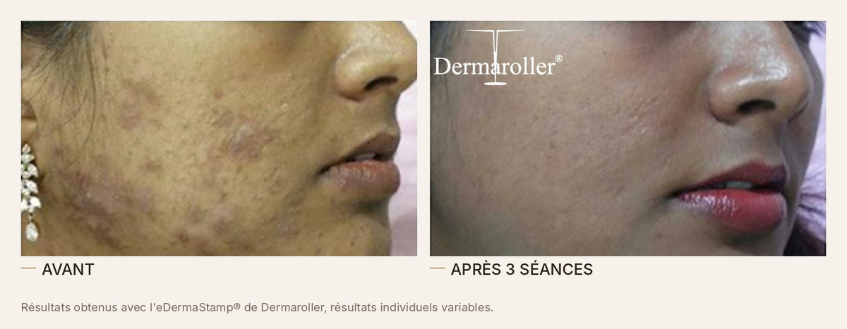 Avant et après un microneedling à l'eDermaStamp de Dermaroller, cicatrices d'acné