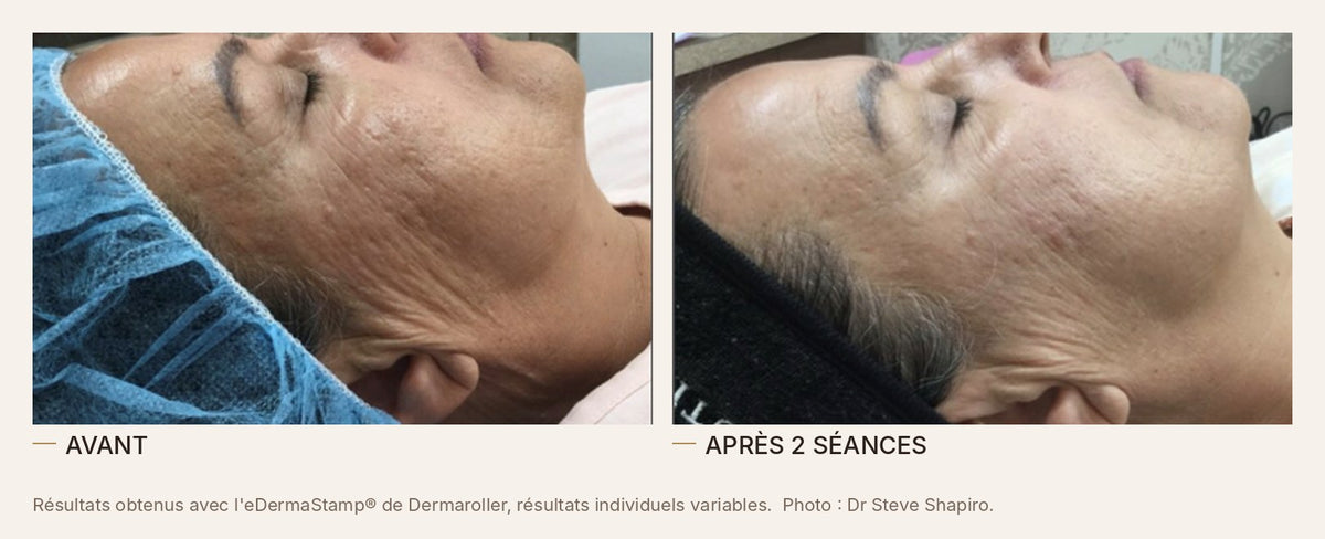 Avant et après un microneedling à l'eDermaStamp de Dermaroller, rides et relâchement du visage