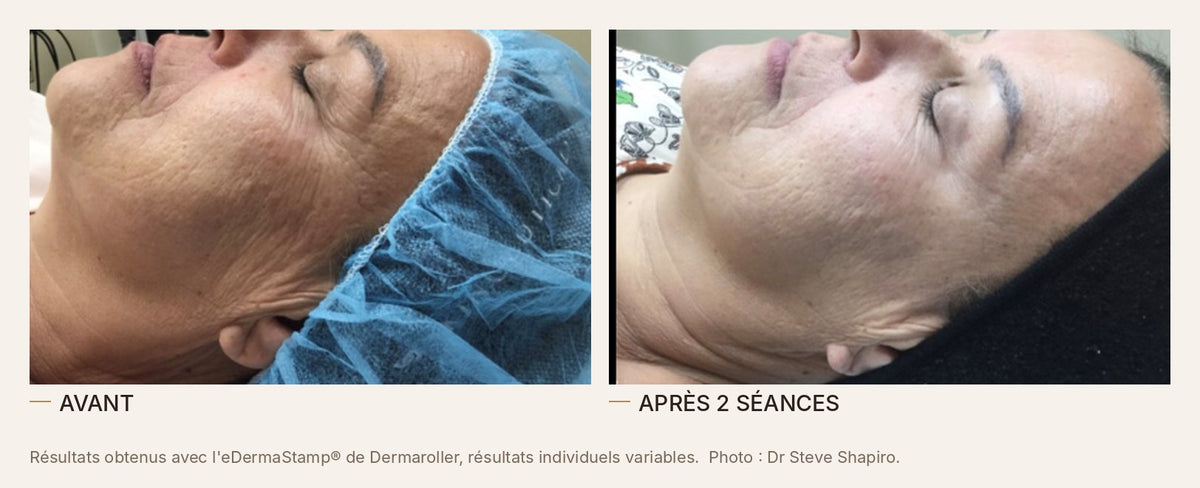 Avant et après un microneedling à l'eDermaStamp de Dermaroller, rides et relâchement du visage