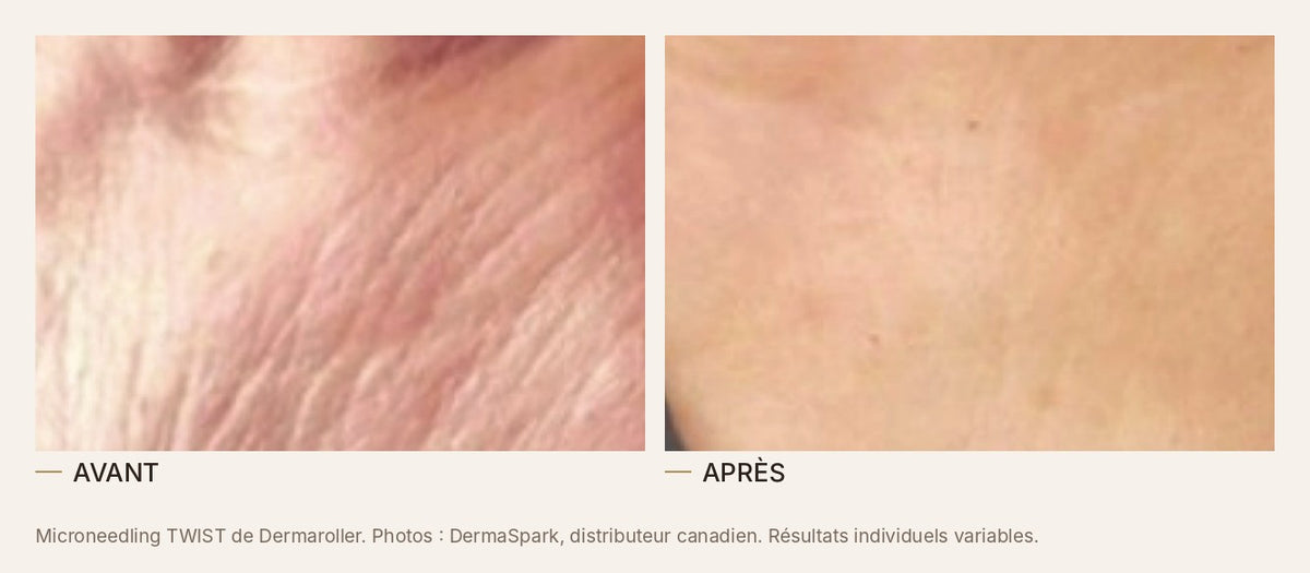 Avant et après un microneedling au TWIST de Dermaroller, rides et texture