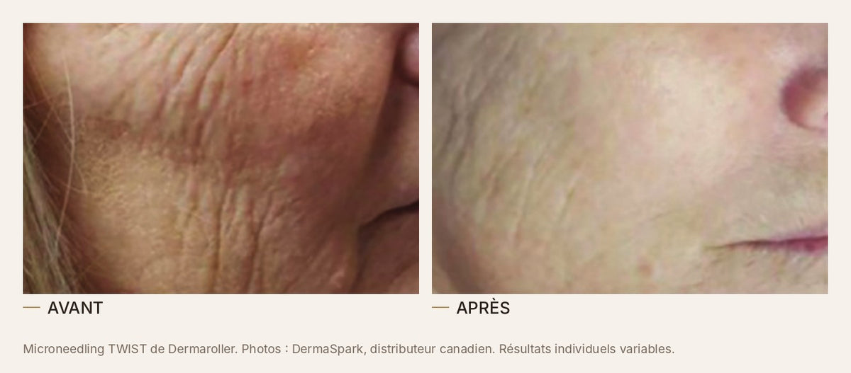 Avant et après un microneedling au TWIST de Dermaroller, rides de la joue