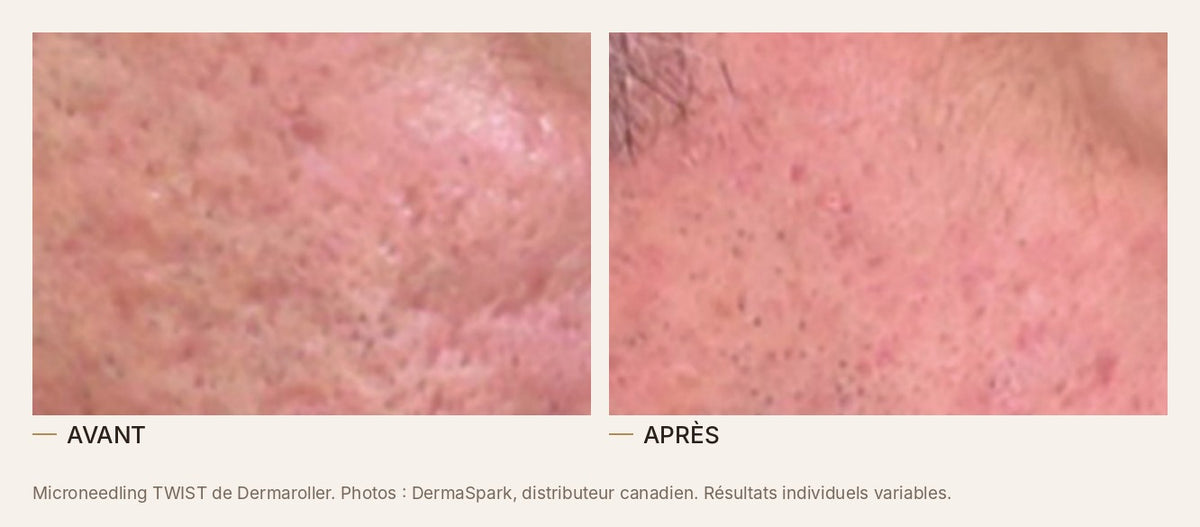 Avant et après un microneedling au TWIST de Dermaroller, cicatrices d'acné et pores
